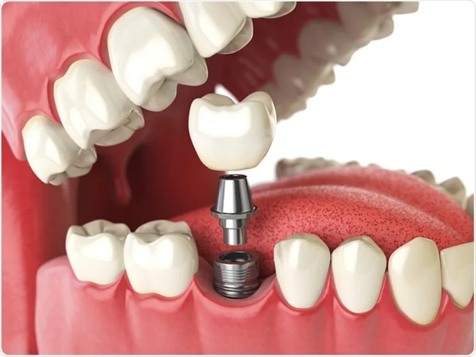Exploring the Benefits of Dental Implants for Missing Teeth