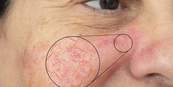 Spider Veins: Can Skincare and Sunscreen Prevent Them?