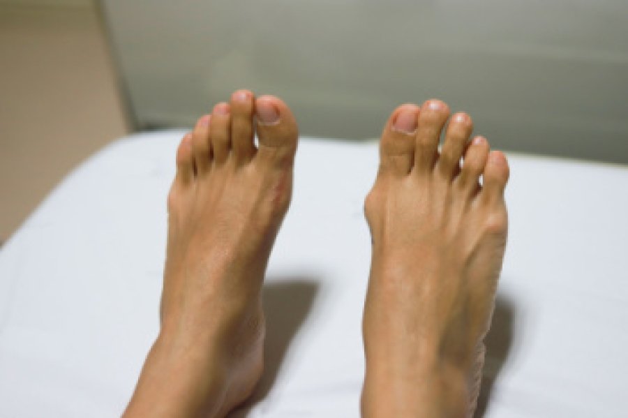 Recognizing the Signs and Symptoms of Bunions