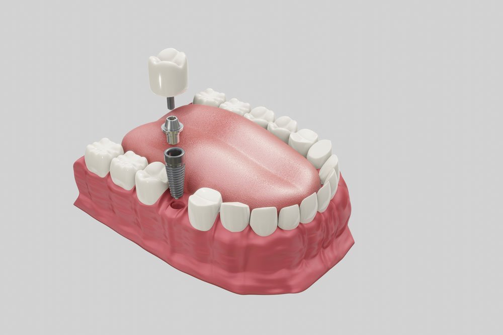 The Lifespan of Dental Implants and When you Should Replace Them