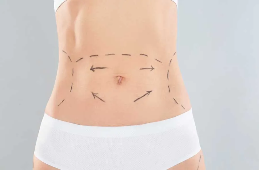 Benefits of Combining Tummy Tuck and Fat Grafting Procedures
