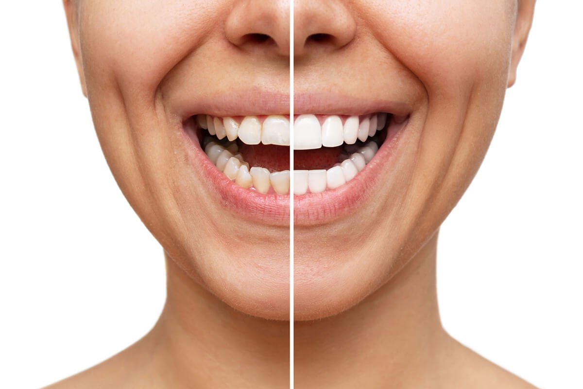 How Veneers Are An Affordable Solution for a White Smile