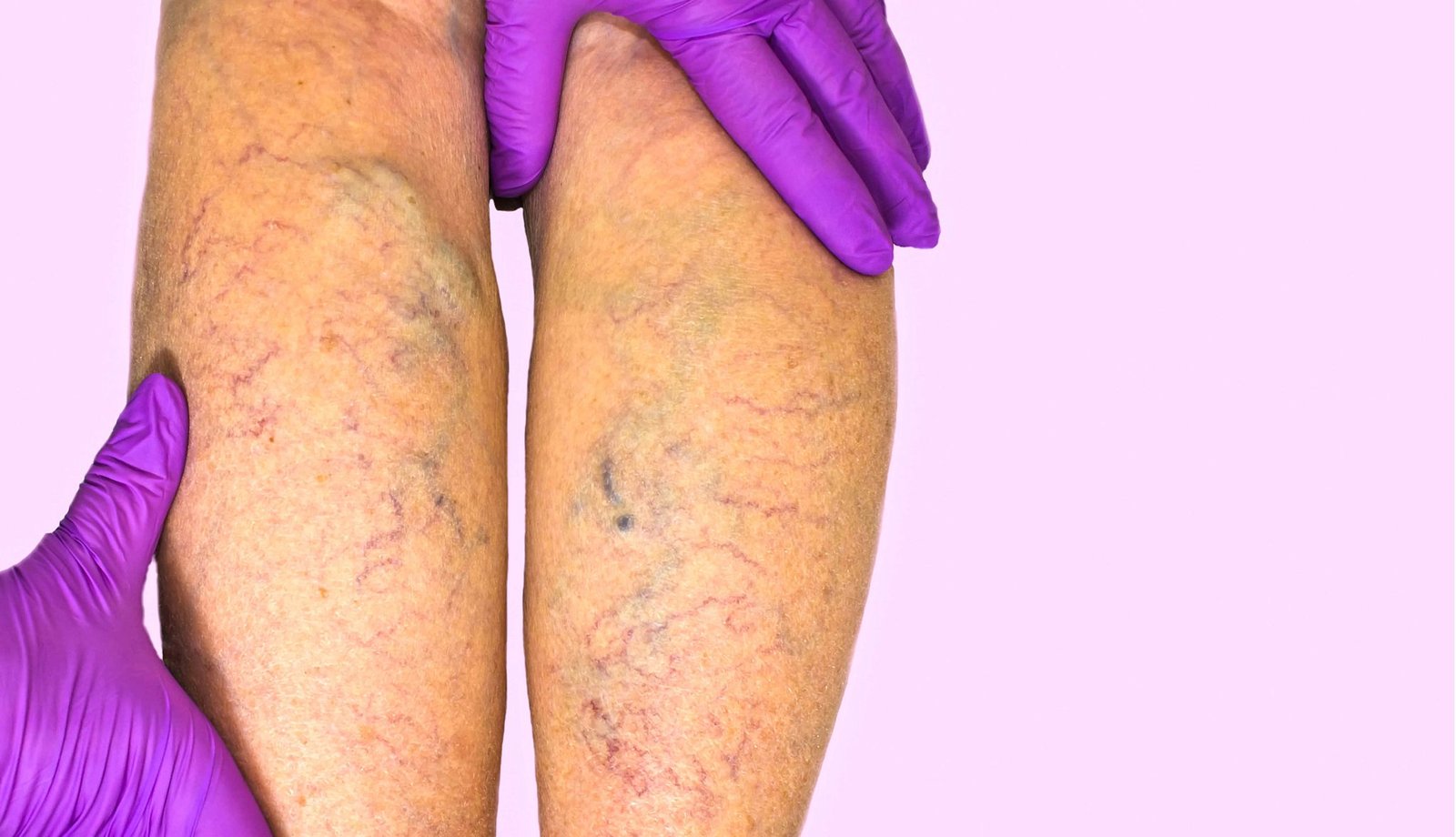 How a Vein Specialist Can Help With Chronic Venous Insufficiency