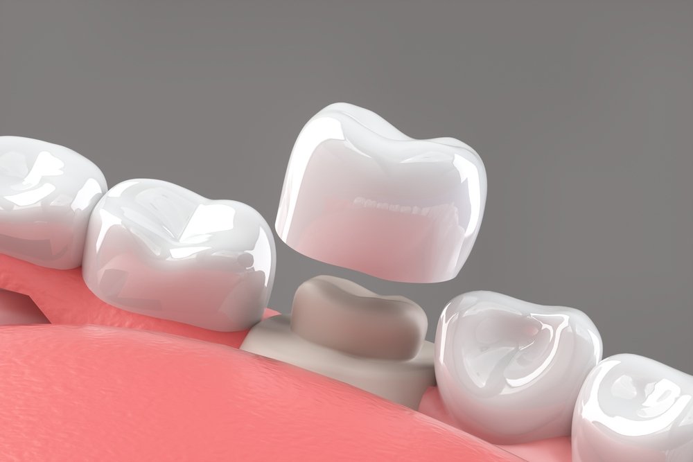 When Should You Get a Dental Crown?