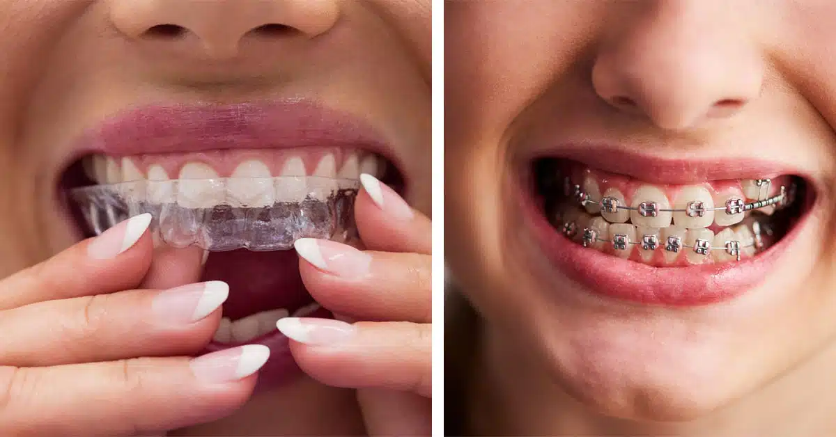 When to Choose Invisalign Over Traditional Braces