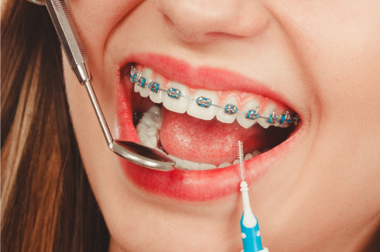 Tips for Maintaining Oral Hygiene With Braces