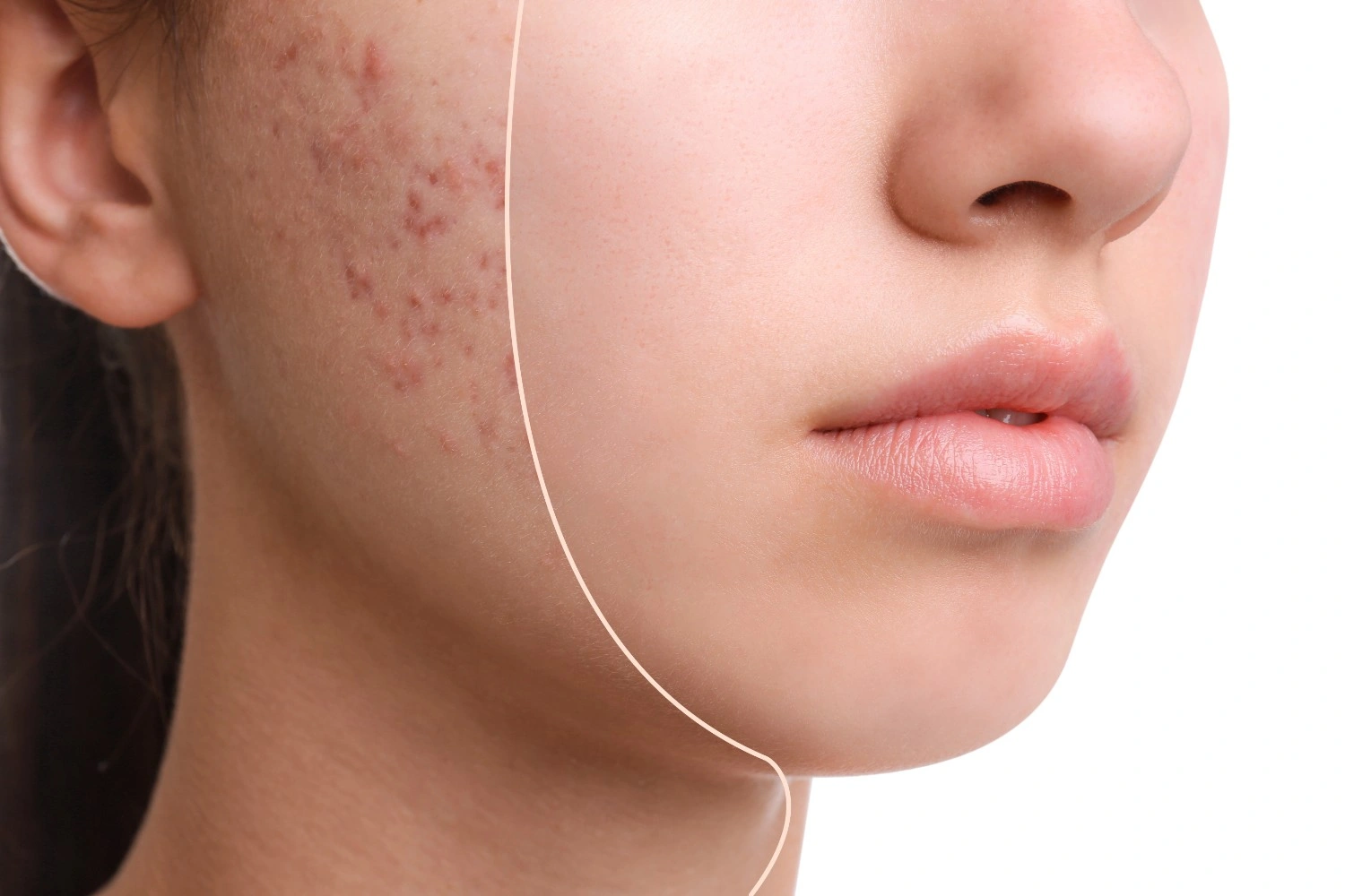 Natural Remedies vs. Medical Treatments for Acne