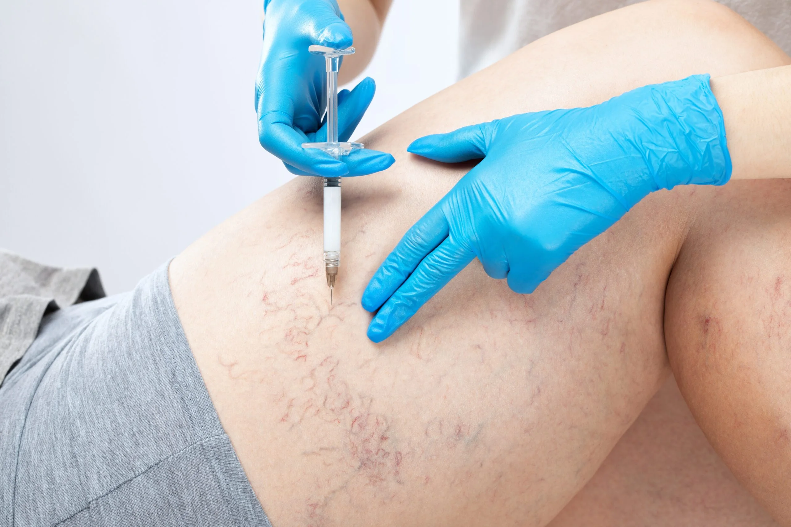 Exploring Non-Invasive Spider Vein Removal Techniques