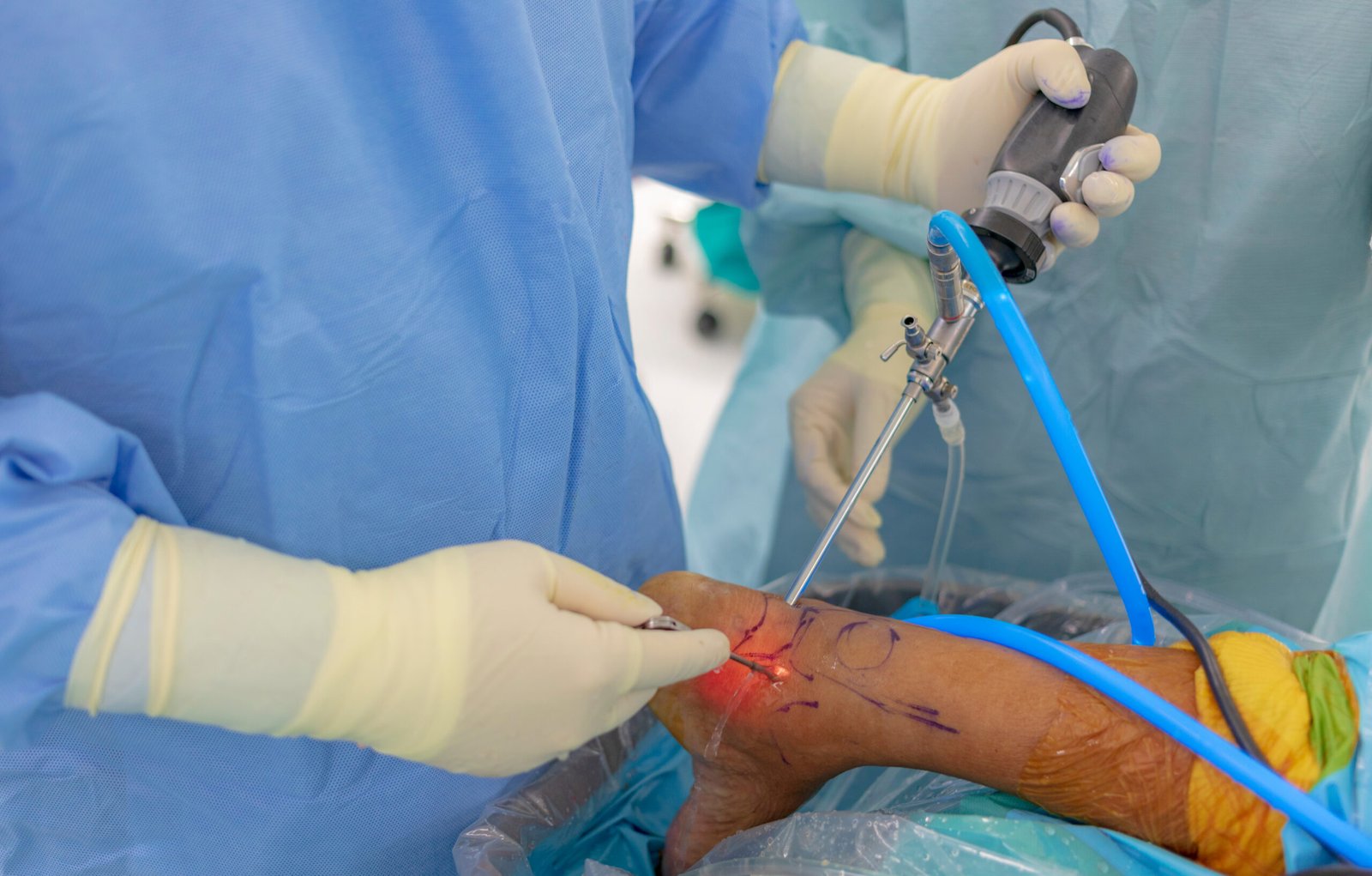 Understanding the Risks and Benefits of Ankle Arthroscopy