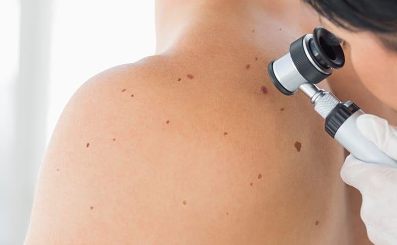 Benefits of Early Detection of Skin Cancer