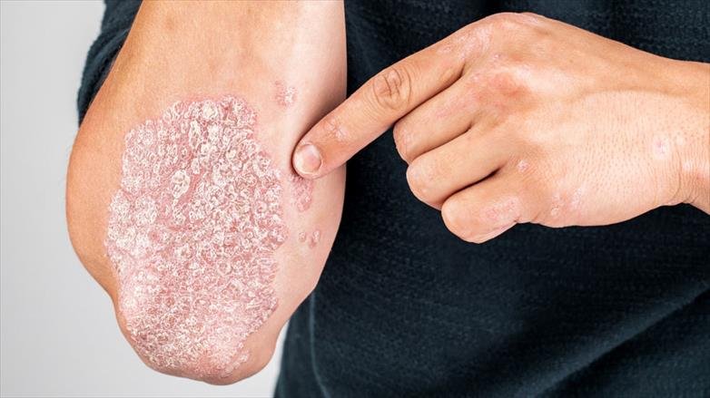 When To Seek Help From a Skin Doctor for Psoriasis