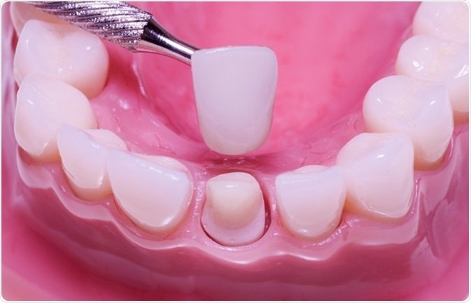 Understanding the Role of Dental Crowns in Restoring Tooth Functionality