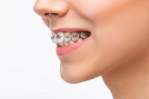 Understanding the Different Types of Braces for Various Needs