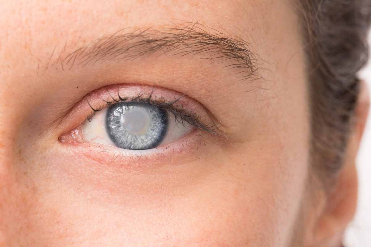 Identifying Early Signs of Cataracts and When to Seek Help