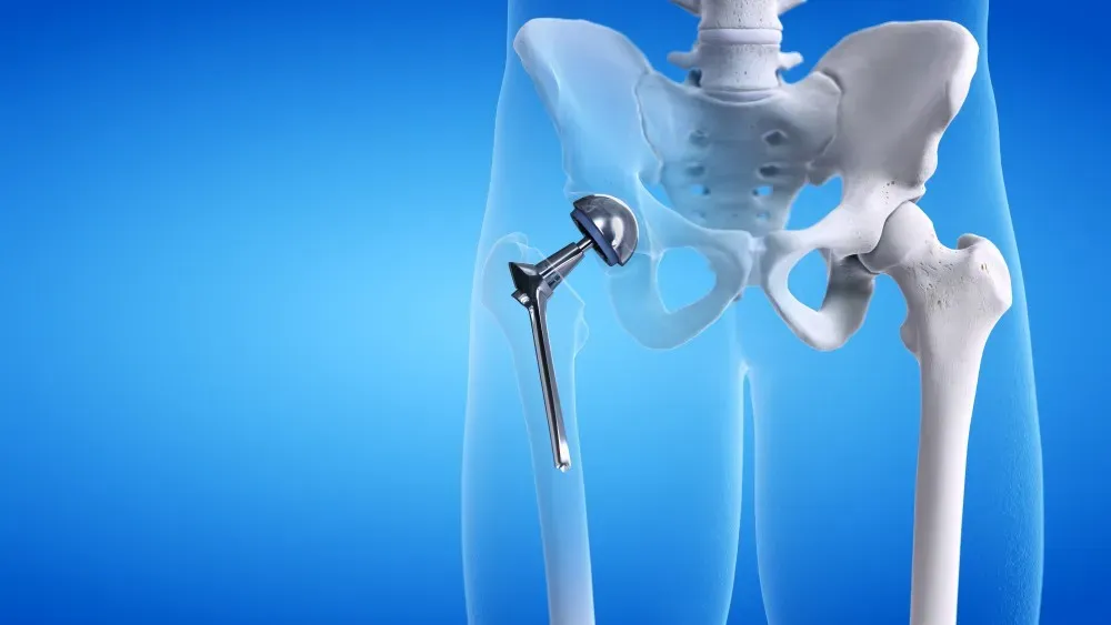 Advantages of Minimally Invasive Hip Replacement Techniques