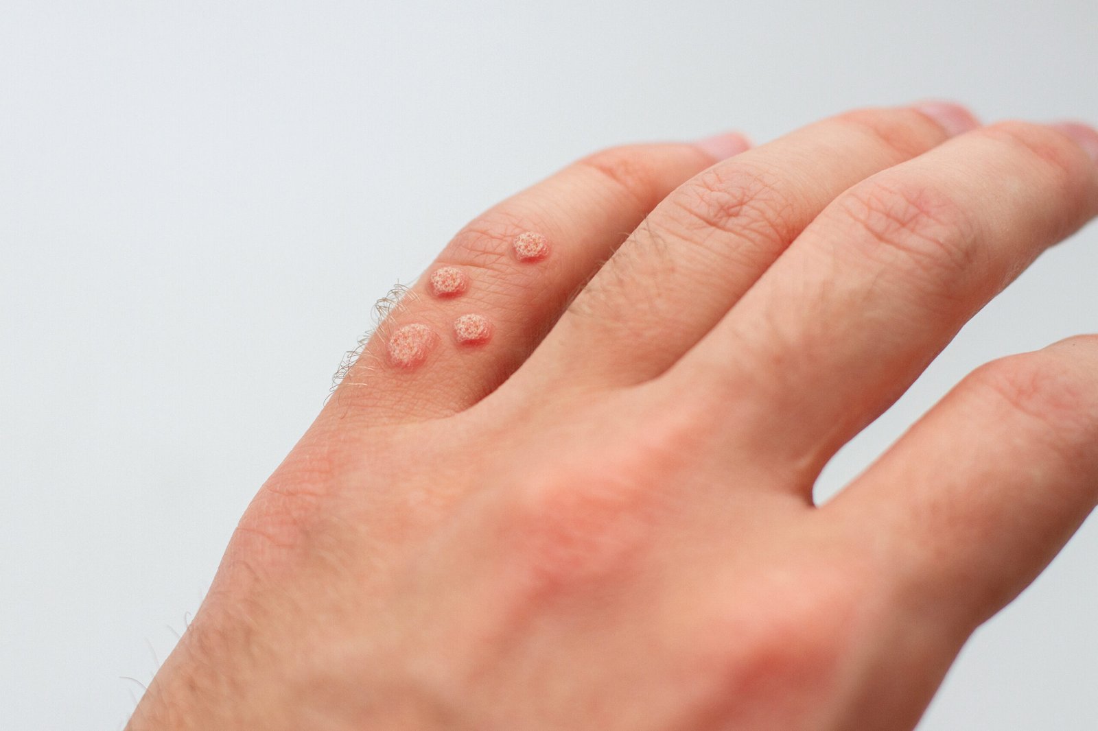 Understanding Warts and Their Treatments