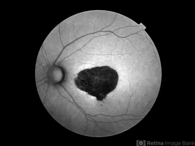Understanding Geographic Atrophy in Macular Degeneration