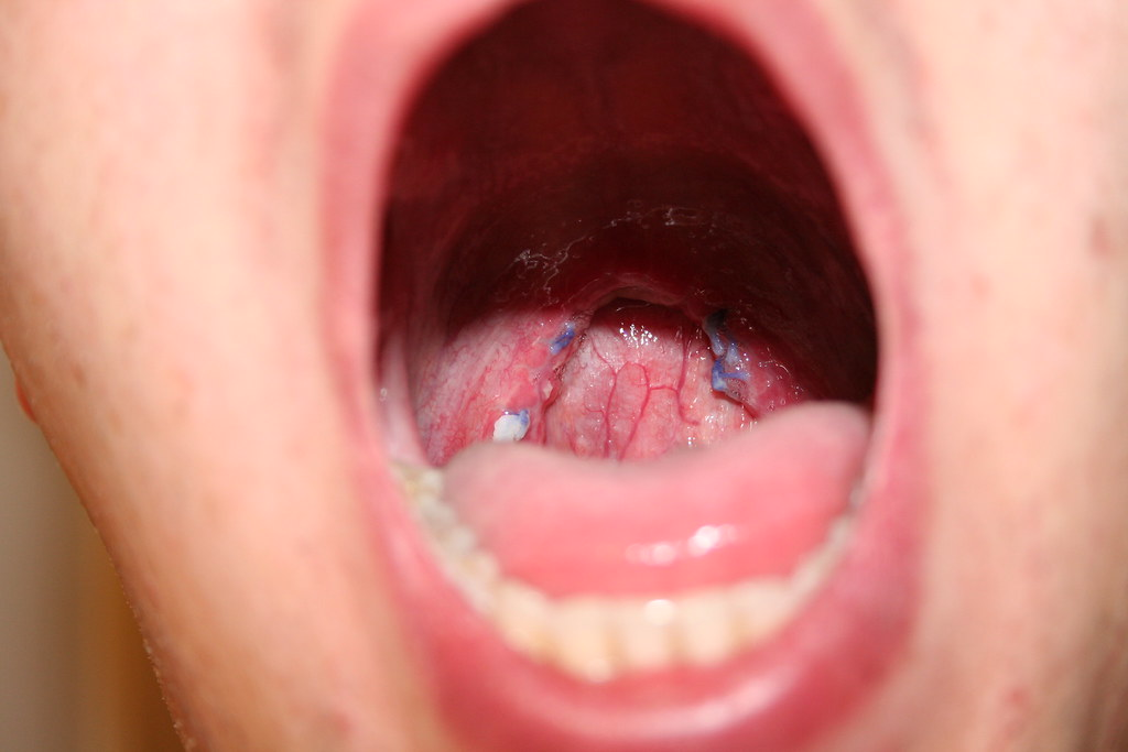 When Do Dissolvable Stitches Dissolve in Mouth?