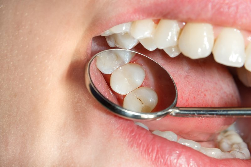 Why Does My Tooth Filling Hurt After Months?